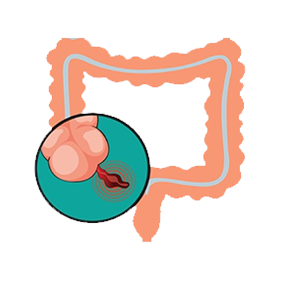Laparoscopic Appendix Surgery