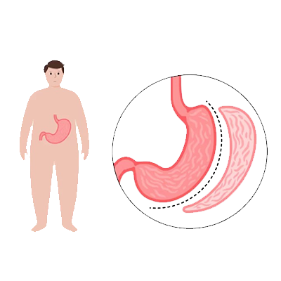 Bariatric Surgery