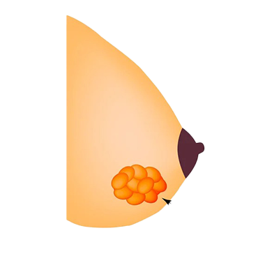 Breast Fibroadenoma Surgery