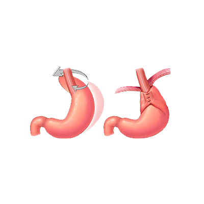 Laparoscopic Fundoplication Surgery