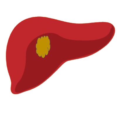 Laparoscopic Liver Abscess Drainage